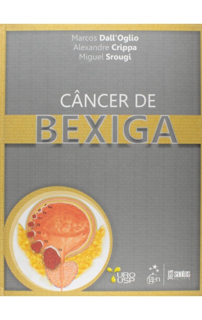 Câncer de Bexiga